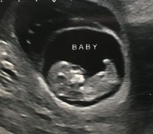Baby at 11.1 weeks with a large subchorionic hematoma hanging overtop (the dark bubble above baby's sac). Baby has their hand over their face - I swear they're facepalming at the situation!