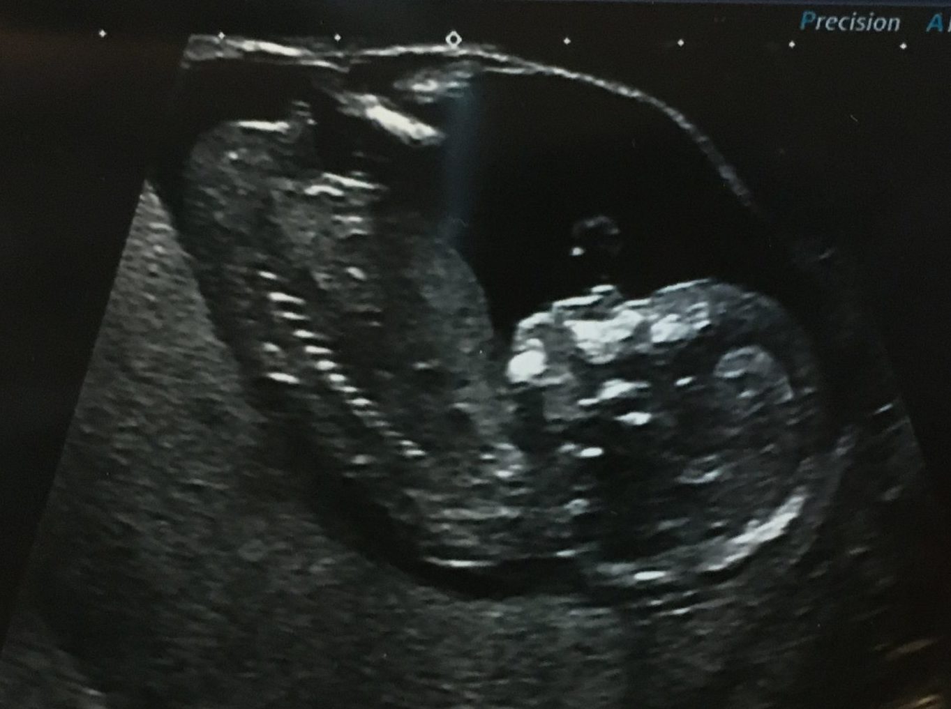 Sarah's fave ultrasound pic of Baby, taken at 13 weeks