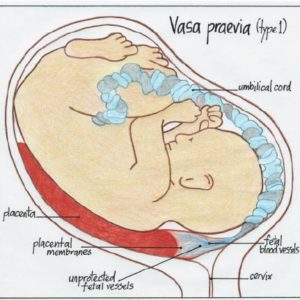 Vasa Previa Type One (with Velamentous Cord Insertion) - The exit for baby is blocked by blood vessels between their head and the cervix
